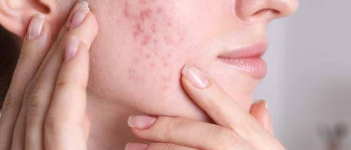 Elle Clinic Melaka – Rawatan Laser Estetik untuk Eczema & Allergi di Paya Rumput & Ayer Keroh